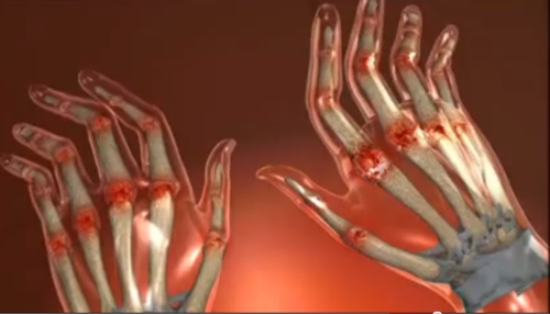 cum să vindece artrite de degete recenzii)