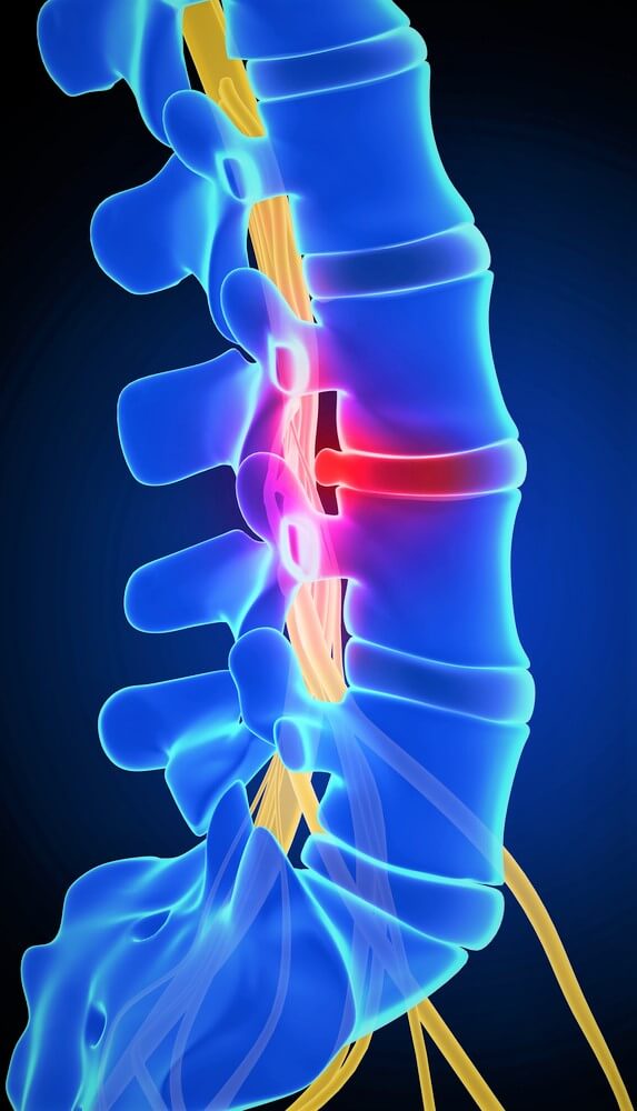tratamentul inflamației coloanei vertebrale prevenirea durerilor de genunchi
