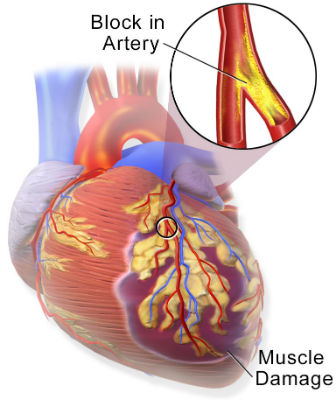 boli de inimă și erecție