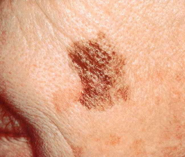 Tratarea cancerului de piele prin terapie combinata