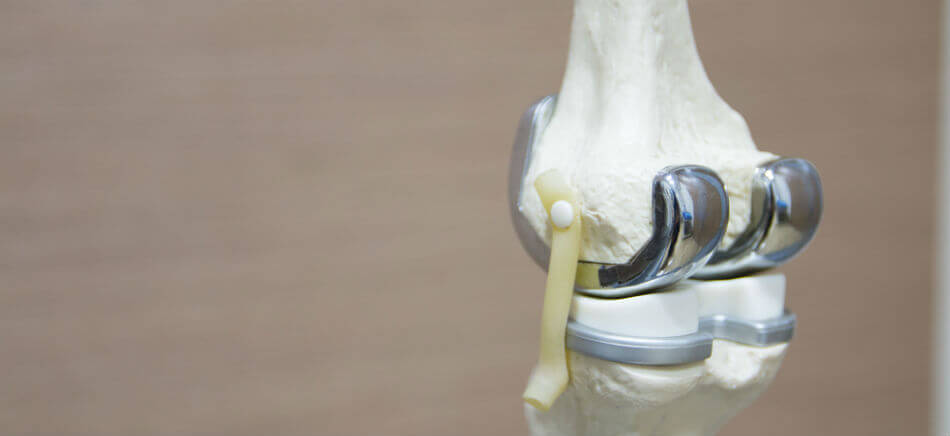 Proteză genunchiului - Shoulder & Knee Surgery