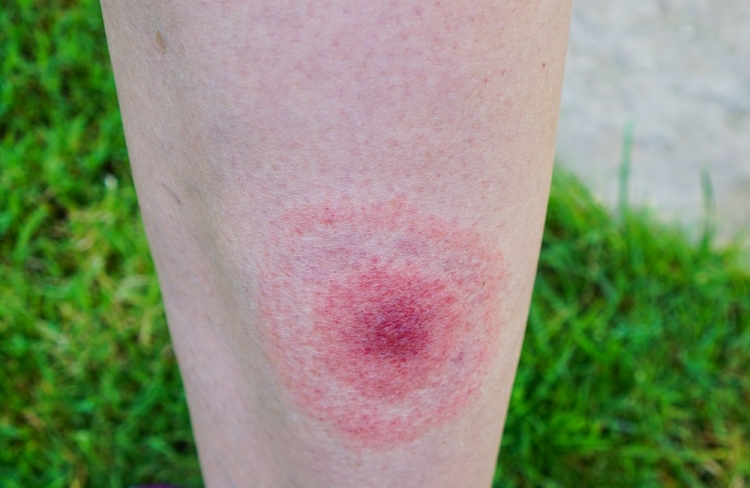 muscatura capusa tratament antibiotic dureri articulare subțiri ale degetelor de la picioare