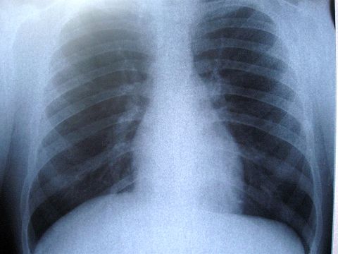 Dureri articulare de cancer pulmonar