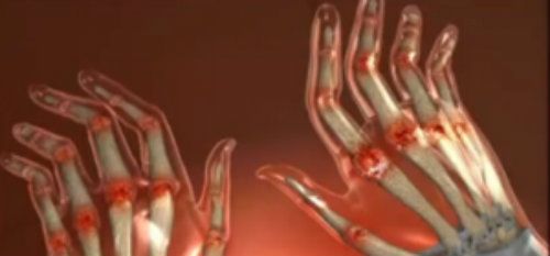 Umflarea Articulațiilor Degetelor Remedii Acasă