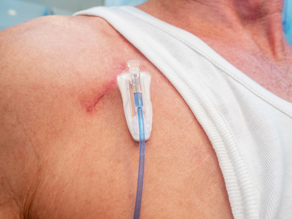 Camera implantabila pentru chimioterapie