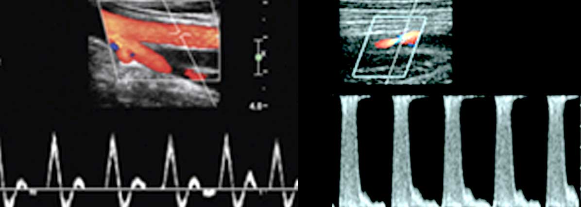 Ecografia doppler arteriala