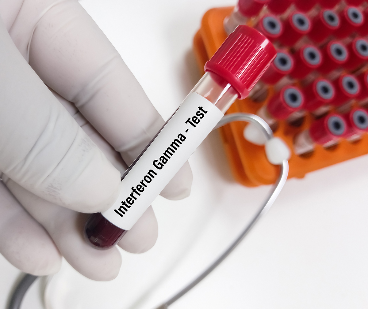 Interferon: tipuri, recomandari si contraindicatii | MedLife