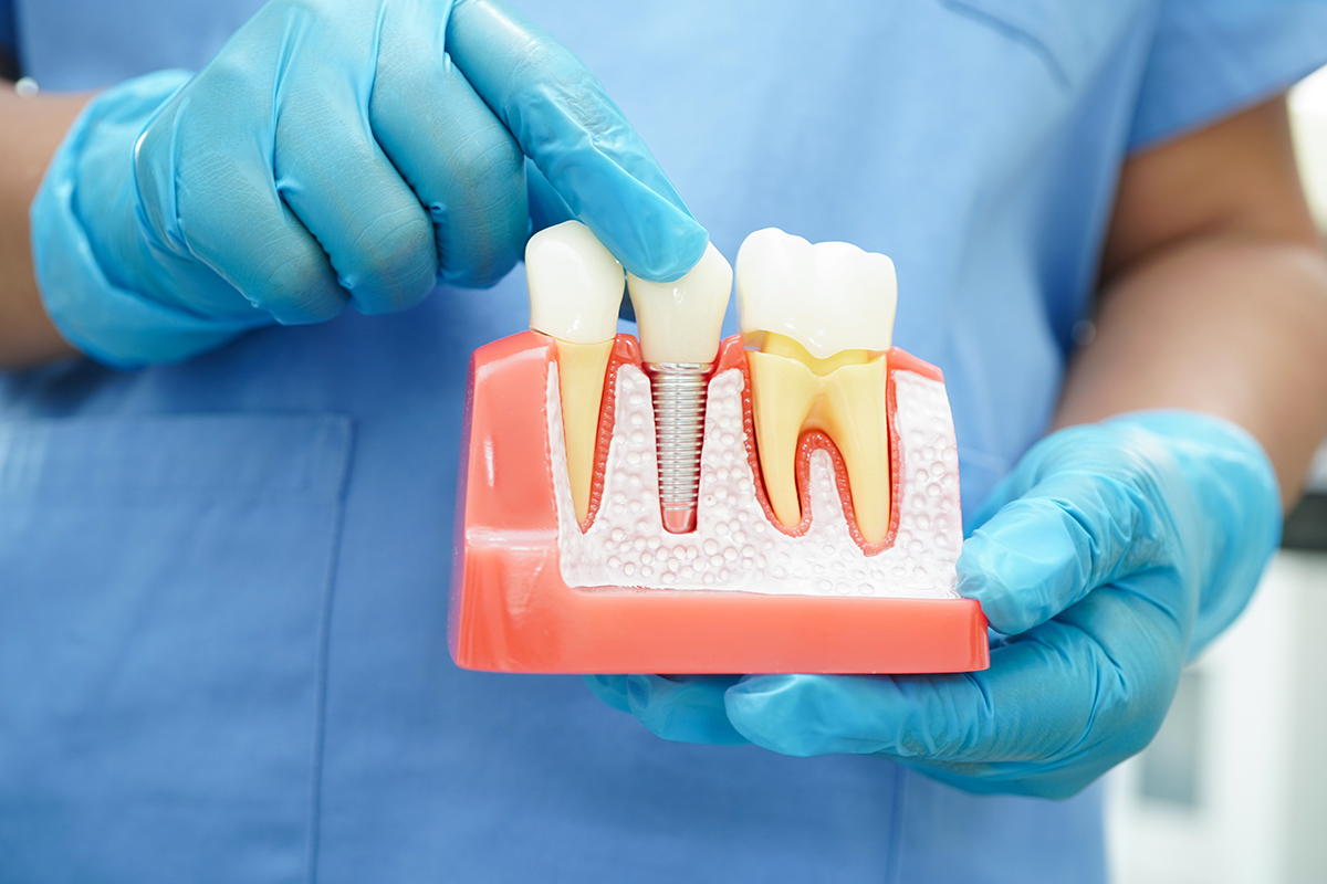 Medic ține în mâini o bucată de maxilar artificial cu implant dentar