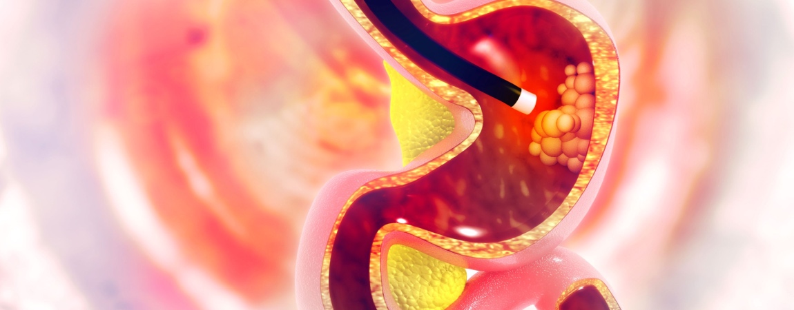 Ilustratie 3D endoscopie digestiva superioara