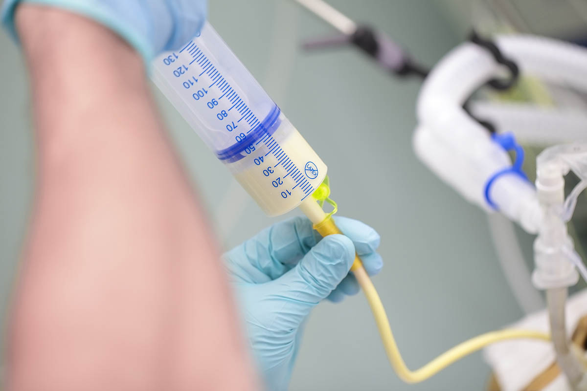 Proces de hranire a unui pacient in stare critica prin sonda de alimentatie, realizat in spital, ilustrand nutritia enterala si ingrijirea medicala specializata.