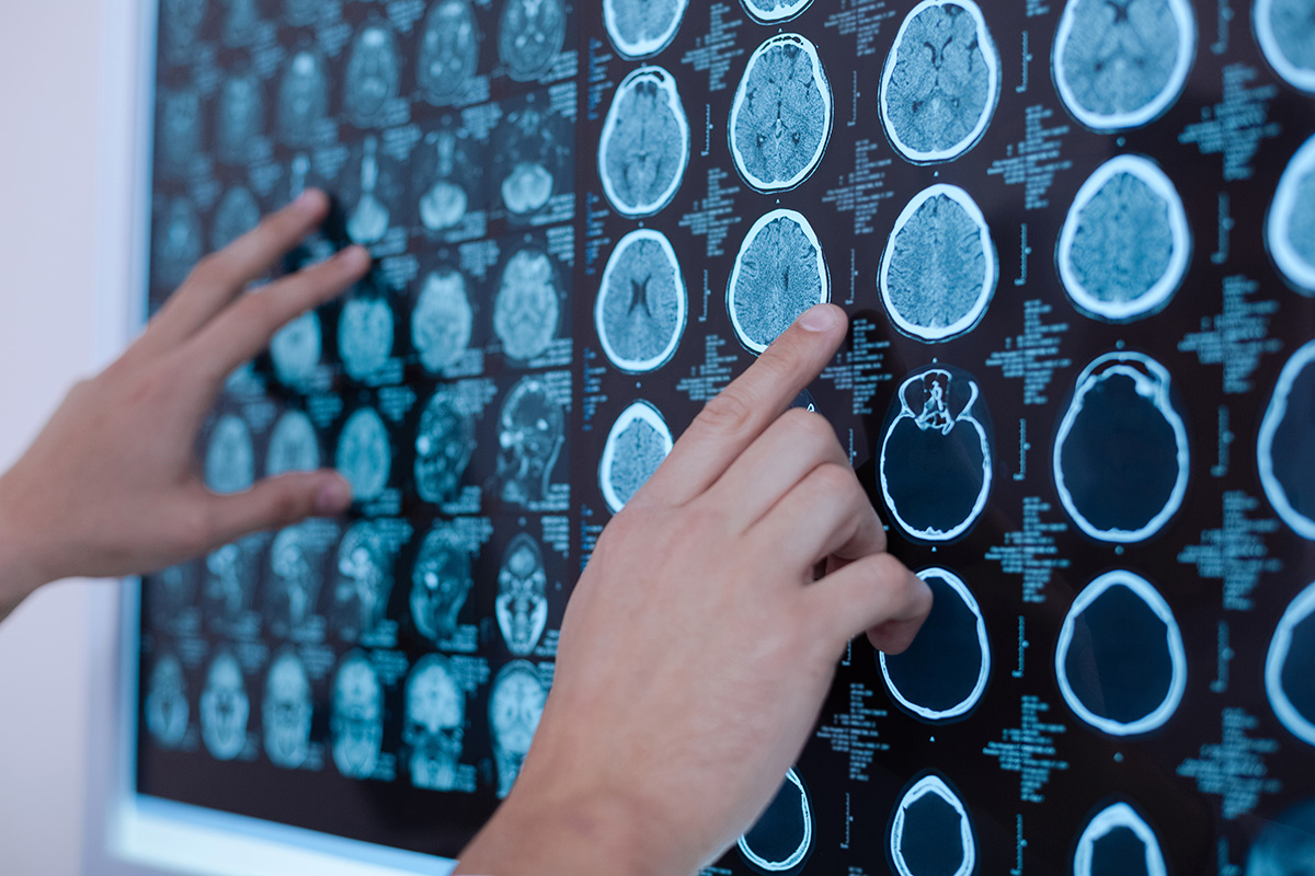 Radiografii ale creierului uman
