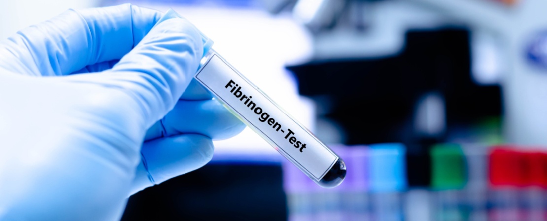 Eprubeta cu proba de sange pentru analiza fibrinogenului, utilizata in laborator pentru evaluarea coagularii si identificarea riscurilor cardiovasculare