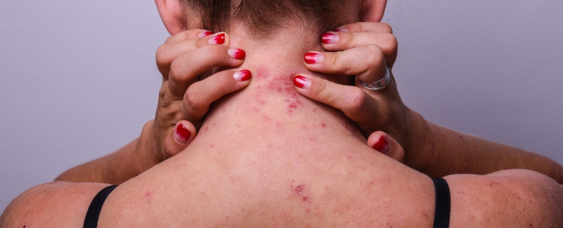 Spate pacienta cu dermatita atopica