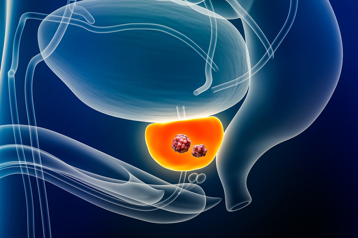 Ilustrație 3D reprezentând cancerul de prostată.