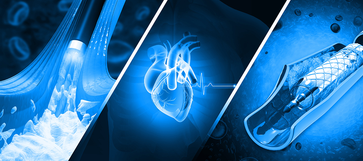 Ilustratie artere afectate de ateroscleroza si angioplastie cu stent