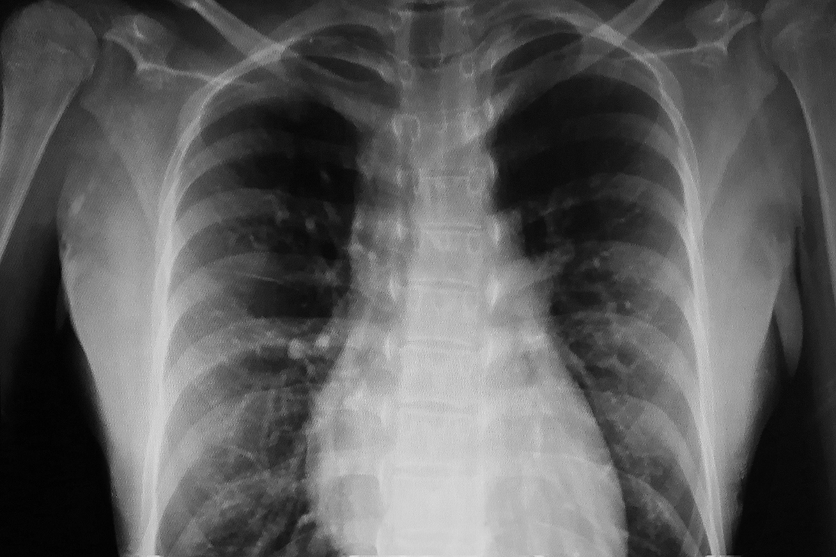 Imagine a unei radiografii la plamani