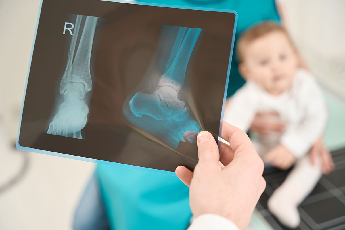 Specialist examineaza radiografia membrului inferior al unui copil