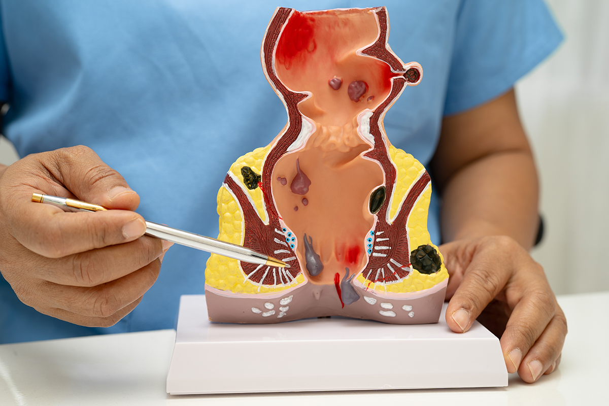 Medic explica anatomia rectului si modificarile produse de hemoroizi
