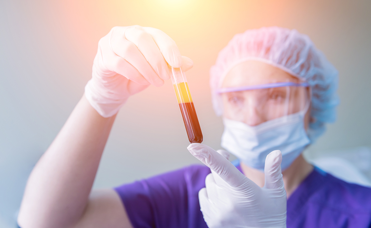 Proba de plasma imbogatita cu trombocite pregatita pentru tratament regenerativ
