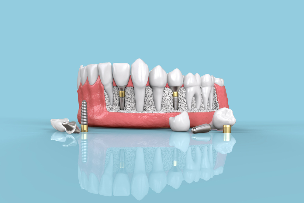 ilustratie 3d pentru implanturile dentare