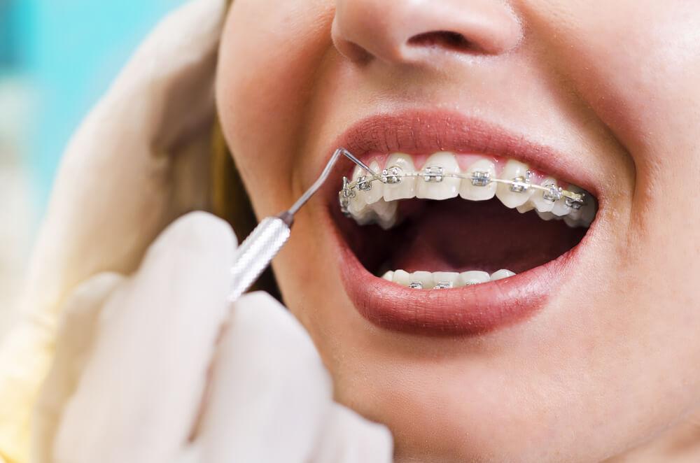 Tratamentul ortodontic la adulți - când este recomandat și cât de eficient este 