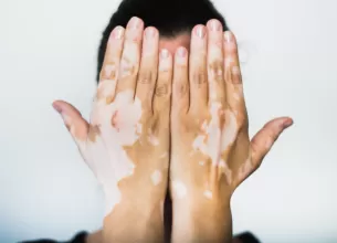 care sunt cauzele depigmentarii pielii