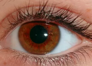 ce este conjunctivita simptomele tratamentul si prevenirea conjunctivitelor bacteriene virale si alergice