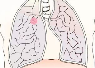 cum poti afla daca ai un risc crescut de a dezvolta cancer pulmonar