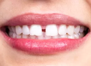 diastema strungareata ce este si ce trebuie sa stii despre ea