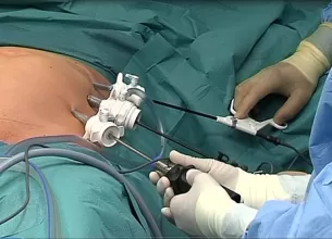 metoda noua minim invaziva de tratament chirurgical pentru hernia ombilicala