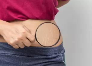 vergeturile ce sunt de ce apar si cum pot fi tratate