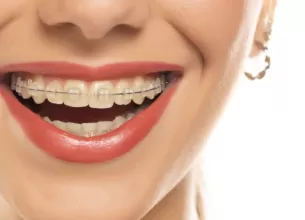 Femeie cu aparat dentar ceramic