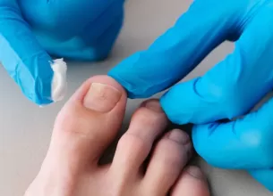 Medic aplicand antimicotic pe unghiile unui pacient