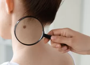 Medic examinand o alunita a unei femei cu lupa, in scop de depistare a cancerului de piele