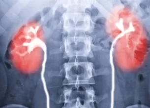 Radiografie intravenoasa pyelograma pentru examinarea tractului urinar