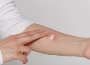 Femeie care aplica crema pe brat pentru a calma mancarimea provocata de o reactie alergica sau dermatita