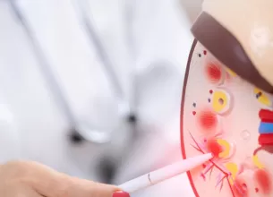 Medic care arata pietre renale pe un mulaj