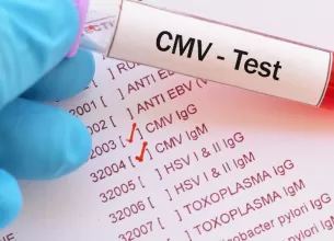 infectia cu citomegalovirus sau cvm