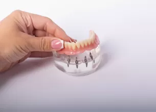 Implant dentar Fast&Fixed pe arcada mandibulara