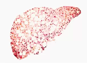 Boala ficatului gras nonalcoolic cauze diagnostic si tratament