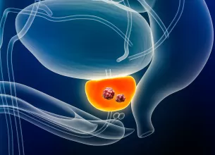 Ilustrație 3D reprezentând cancerul de prostată.