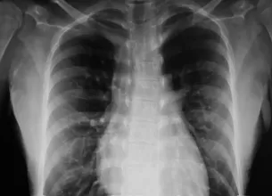 Imagine a unei radiografii la plamani