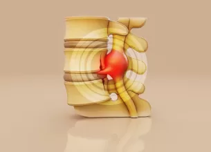 Ilustratie a unei hernii de disc la nivelul coloanei lombare