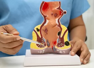 Medic explica anatomia rectului si modificarile produse de hemoroizi