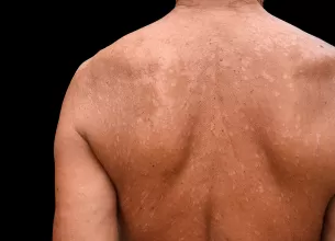 Tinea versicolor