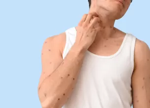 Baiat care scarpina eruptiile de varicela