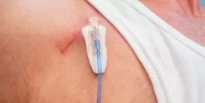 Camera implantabila pentru chimioterapie