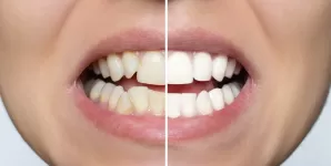 Fatete dentare avantaje dezavantaje recomandari