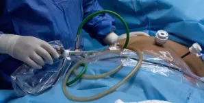 Sleeveul gastric pe cale endoscopica esg