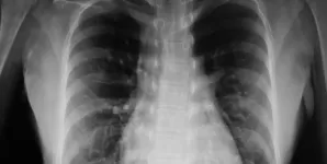 Imagine a unei radiografii la plamani